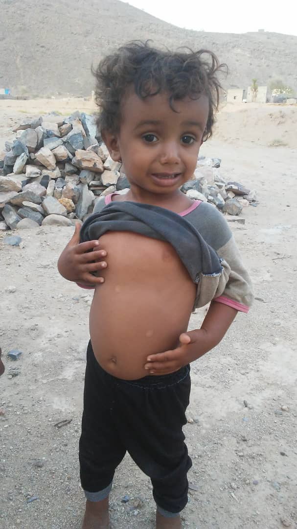 You are currently viewing Pictures of Fuad from Bani Quis area of Hajjah who was about to die due to the hunger